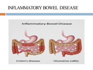 INFLAMMATORY BOWEL DISEASE
 