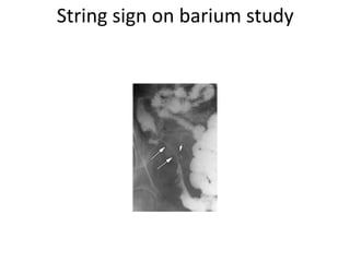 String sign on barium study

 