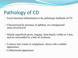 Pathology of CD
 Focal intestinal inflammation is the pathologic hallmark of CD
 Characterised by presence of aphthae on a background
uninvolved bowel
 Minute superficial ulcers, ranging from barely visible to 3 mm,
and are surrounded by a halo of erythema
 Coalesce into Linear or serpiginous ulcers with a stellate
appearance.
 Cobblestoned appearance
 
