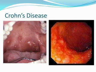 Crohn’s Disease
 