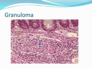 Granuloma
 
