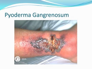 Pyoderma Gangrenosum
 