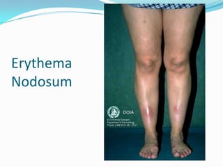 Erythema
Nodosum
 