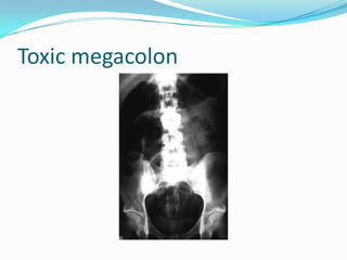 Toxic megacolon
 