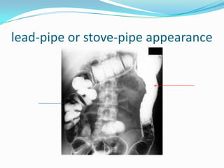 lead-pipe or stove-pipe appearance
 