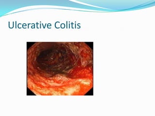Ulcerative Colitis
 