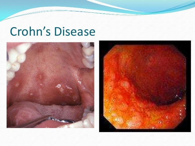 Inflammatory bowel disease,