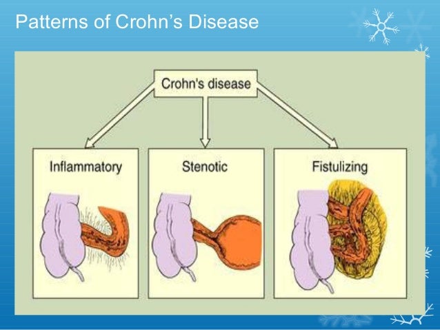  Inflammatory bowel disease 