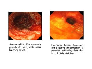 Severe colitis. The mucosa is
grossly denuded, with active
bleeding noted.
Narrowed lumen. Relatively
little active inflammation is
present, indicating that this
is a cicatrix stricture
 