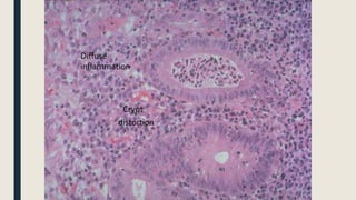 Crypt
distortion
Diffuse
inflammation
 