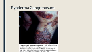 Pyoderma Gangrenosum
 