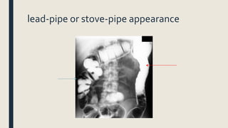 lead-pipe or stove-pipe appearance
 