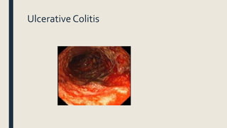 Ulcerative Colitis
 