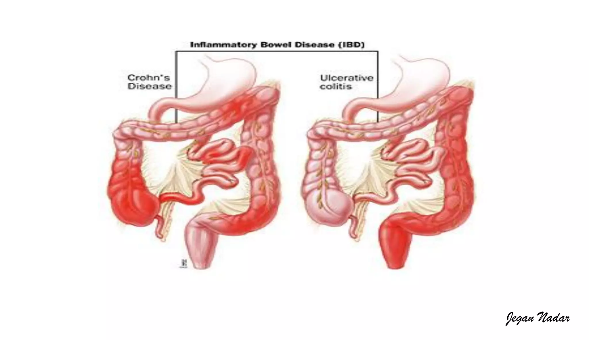 Pathophysiology of Inflammatory bowel disease | PDF
