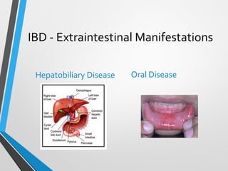 Inflammatory bowel disease  - Hiren Chatrola