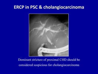 ERCP in PSC & cholangiocarcinoma
Dominant stricture of proximal CHD should be
considered suspicious for cholangiocarcinoma
 