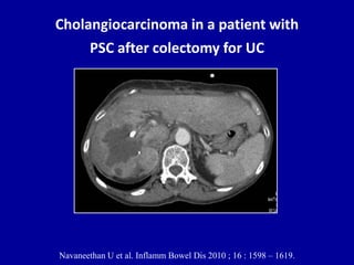 Cholangiocarcinoma in a patient with
PSC after colectomy for UC
Navaneethan U et al. Inflamm Bowel Dis 2010 ; 16 : 1598 – 1619.
 