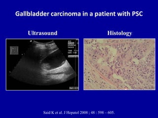Gallbladder carcinoma in a patient with PSC
Said K et al. J Hepatol 2008 ; 48 : 598 – 605.
Ultrasound Histology
 