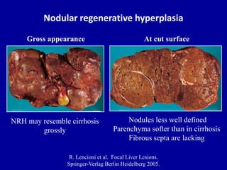 Nodular regenerative hyperplasia
R. Lencioni et al. Focal Liver Lesions.
Springer-Verlag Berlin Heidelberg 2005.
NRH may resemble cirrhosis
grossly
Gross appearance
Nodules less well defined
Parenchyma softer than in cirrhosis
Fibrous septa are lacking
At cut surface
 