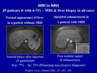 MRI in NRH
45 patients tt with 6-TG – MRI & liver biopsy in all cases
Seiderer J et al. J Hepatol 2005 ; 43 : 303 – 309.
Speckled enhancement in
a patient with NRH
Fine-nodular aspect
of enhancement
Normal appearance of liver
in a patient without NRH
Arterial phase after injection
of gadolinium
Sen: 77% – Sp: 72% (Promising non-invasive diagnosis)
 