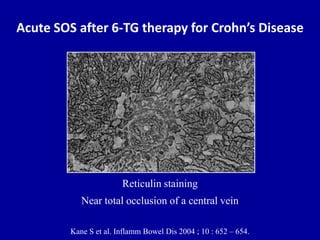 Acute SOS after 6-TG therapy for Crohn’s Disease
Reticulin staining
Near total occlusion of a central vein
Kane S et al. Inflamm Bowel Dis 2004 ; 10 : 652 – 654.
 