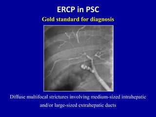 ERCP in PSC
Diffuse multifocal strictures involving medium-sized intrahepatic
and/or large-sized extrahepatic ducts
Gold standard for diagnosis
 
