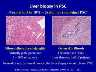 Liver biopsy in PSC
Fibro-obliterative cholangitis
Virtually pathognomonic
5 – 10% of patients
Onion skin fibrosis
Characteristic lesion
Less than one half of patients
Normal in 5 to 10% – Useful for small-duct PSC
EASL Clinical Practice Guidelines. J Hepatol 2009 ; 51 : 237 – 267.
Normal or nearly normal nonspecific liver biopsy cannot rule out PSC
 