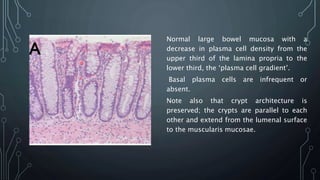 Normal large bowel mucosa with a
decrease in plasma cell density from the
upper third of the lamina propria to the
lower third, the ‘plasma cell gradient’.
Basal plasma cells are infrequent or
absent.
Note also that crypt architecture is
preserved; the crypts are parallel to each
other and extend from the lumenal surface
to the muscularis mucosae.
 