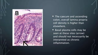  The caecum and ascending
colon, overall lamina propria
cell density is higher than
elsewhere.
 Basal plasma cells may be
seen at these sites (arrow)
and should not necessarily be
interpreted as chronic
inflammation.
 