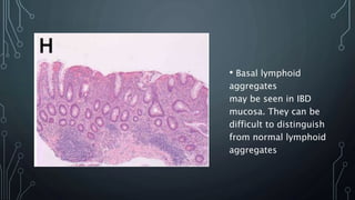 • Basal lymphoid
aggregates
may be seen in IBD
mucosa. They can be
difficult to distinguish
from normal lymphoid
aggregates
 