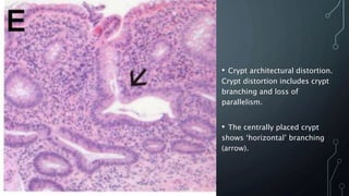 • Crypt architectural distortion.
Crypt distortion includes crypt
branching and loss of
parallelism.
• The centrally placed crypt
shows ‘horizontal’ branching
(arrow).
 