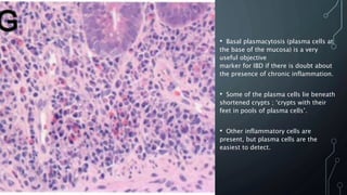 • Basal plasmacytosis (plasma cells at
the base of the mucosa) is a very
useful objective
marker for IBD if there is doubt about
the presence of chronic inflammation.
• Some of the plasma cells lie beneath
shortened crypts ; ‘crypts with their
feet in pools of plasma cells’.
• Other inflammatory cells are
present, but plasma cells are the
easiest to detect.
 
