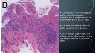 • An irregular or villiform mucosal
surface in the large bowel is
abnormal and is a useful marker for
inflammatory bowel disease (IBD).
• It is more prevalent in ulcerative
colitis than in Crohn’s disease.
• Severe diffuse crypt atrophy and
diffuse chronic inflammation are also
apparent in this case of ulcerative
colitis
 