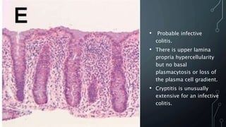 • Probable infective
colitis.
• There is upper lamina
propria hypercellularity
but no basal
plasmacytosis or loss of
the plasma cell gradient.
• Cryptitis is unusually
extensive for an infective
colitis.
 