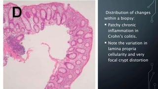Distribution of changes
within a biopsy:
 Patchy chronic
inflammation in
Crohn’s colitis.
 Note the variation in
lamina propria
cellularity and very
focal crypt distortion
 