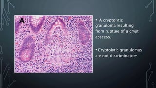 • A cryptolytic
granuloma resulting
from rupture of a crypt
abscess.
• Cryptolytic granulomas
are not discriminatory
 