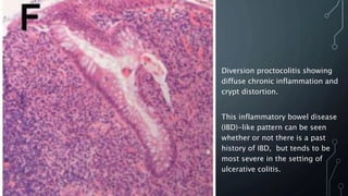 Diversion proctocolitis showing
diffuse chronic inflammation and
crypt distortion.
This inflammatory bowel disease
(IBD)-like pattern can be seen
whether or not there is a past
history of IBD, but tends to be
most severe in the setting of
ulcerative colitis.
 
