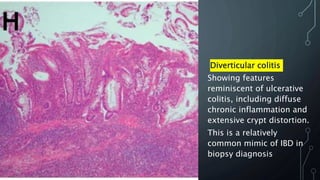 Diverticular colitis
Showing features
reminiscent of ulcerative
colitis, including diffuse
chronic inflammation and
extensive crypt distortion.
This is a relatively
common mimic of IBD in
biopsy diagnosis
 