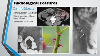INFLAMMATORY BOWEL DISEASE Crohns And Ulcerative Coliits PPTX inflammatory-bowel-disease-crohns-and-ulcerative-coliits-pptx