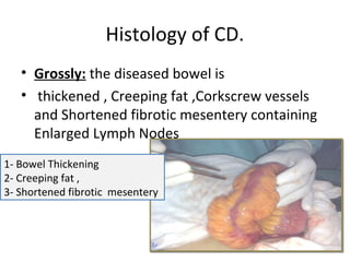 Histology of CD.
• Grossly: the diseased bowel is
• thickened , Creeping fat ,Corkscrew vessels
and Shortened fibrotic mesentery containing
Enlarged Lymph Nodes
1- Bowel Thickening
2- Creeping fat ,
3- Shortened fibrotic mesentery
 