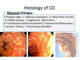 Histology of CD.
• Mucosal changes :
1-Pinpoint Hges , 2- Apthous ulcerations , 3- Deep linear fissures
4- Cobble stoning . 5- Segmental - Skip lesions ,
6- Full thickness bowel involvement ( Transmural inflammation )
= sinuses –fistulas ,7-Granulomas (40-60%)
 