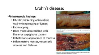 Crohn’s disease:
Macroscopic findings:
• Fibrotic thickening of intestinal
wall with narrowing of lumen.
• Fat wrapping
• Deep mucosal ulceration with
linear or serpiginous pattern
• Cobblestone appearance of mucosa
• Inflammatory masses,mesenteric
abscess and fiistulas.
 