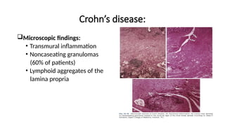Crohn’s disease:
Microscopic findings:
• Transmural inflammation
• Noncaseating granulomas
(60% of patients)
• Lymphoid aggregates of the
lamina propria
 