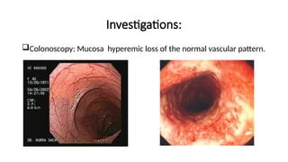 Investigations:
Colonoscopy: Mucosa hyperemic loss of the normal vascular pattern.
 