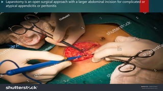  Laparotomy is an open surgical approach with a larger abdominal incision for complicated or
atypical appendicitis or peritonitis
 