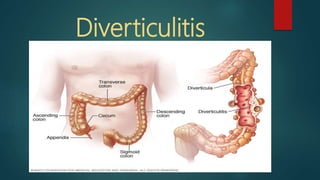 Diverticulitis
 