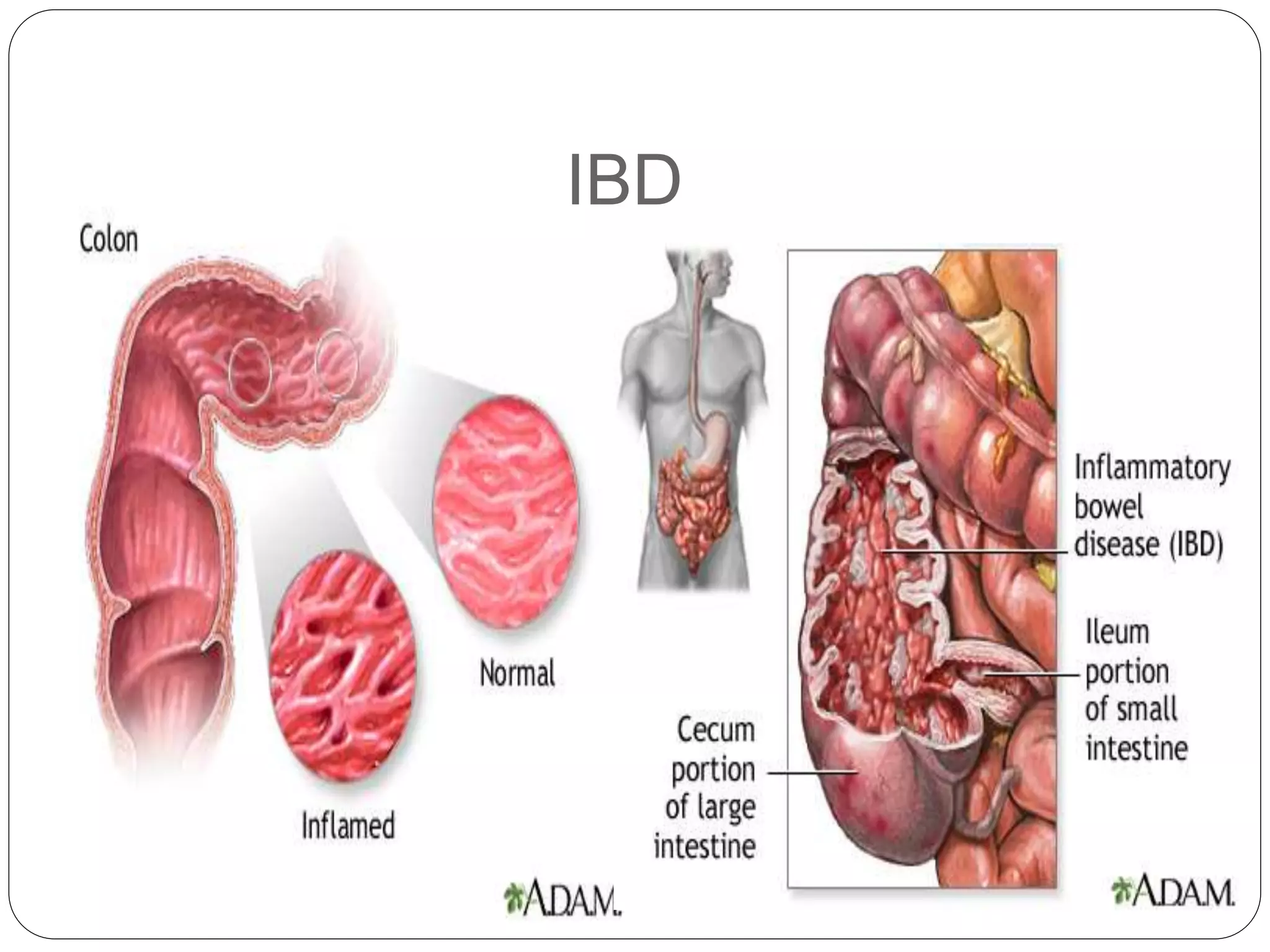 View of Inflammatory bowel diseases | PPTX