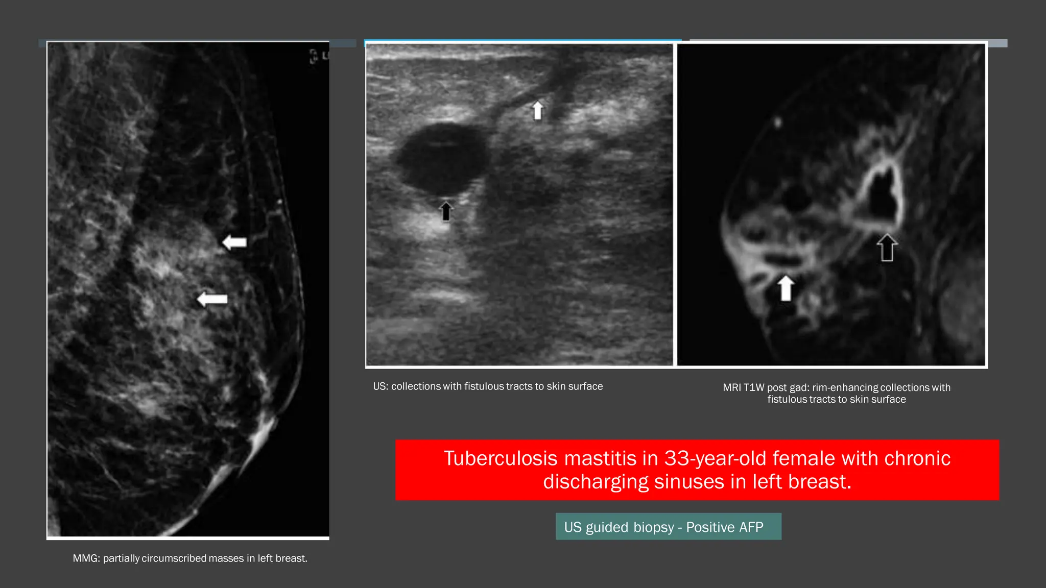 Inflammatory breast disease handout pdf blood disorders diseases
