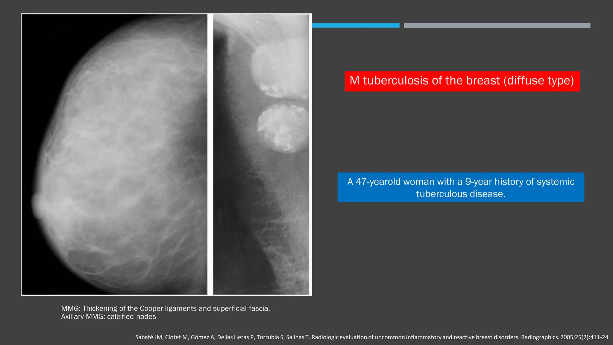 Inflammatory breast disease handout pdf blood disorders diseases