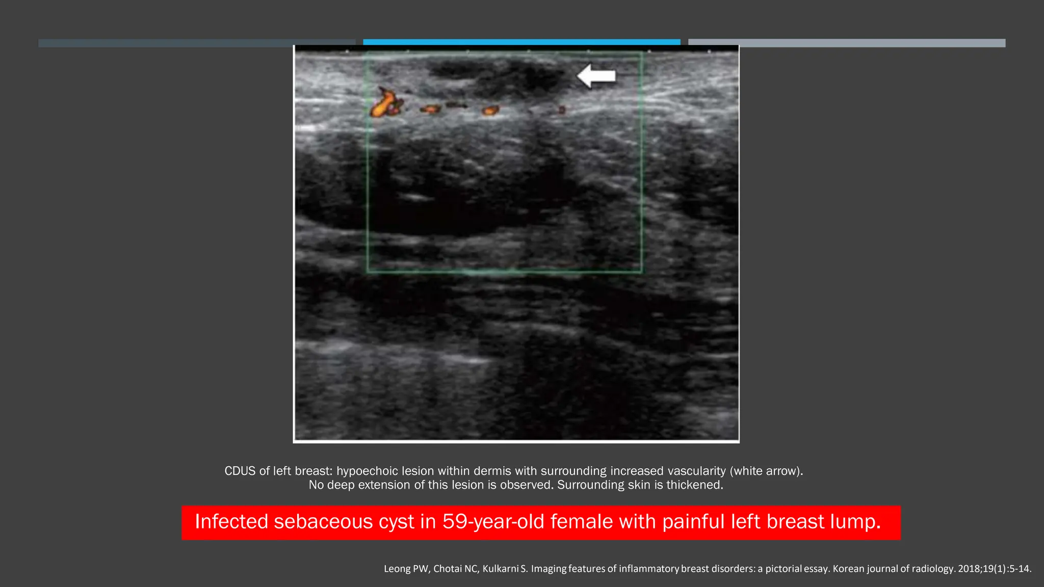 Inflammatory breast disease handout pdf blood disorders diseases
